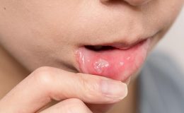 Dudakta uçuk neden çıkar, uçuk nasıl geçer? Stresten dudak uçuklaması…