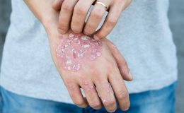 Uyuz vakaları yeniden artışa geçti! En büyük problem ise…